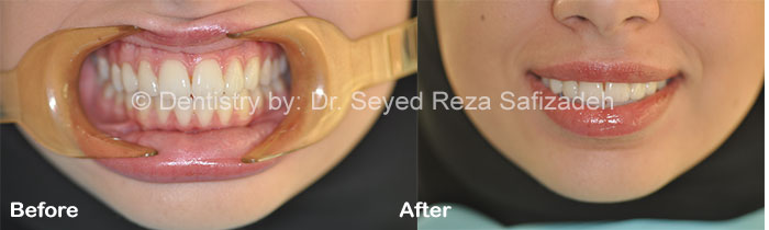 Before and After in Cosmetic Dentistry