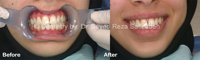 Before and After in Cosmetic Dentistry
