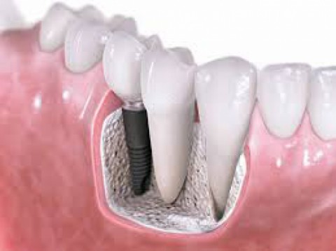 A New Quality Of Life With Dental Implant