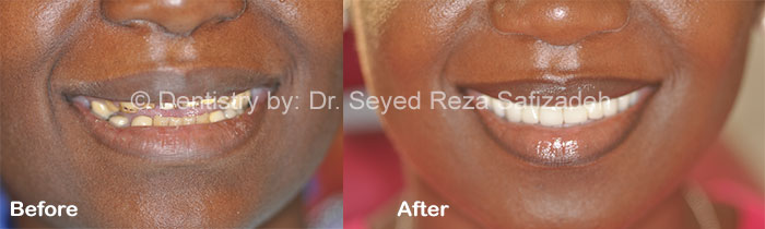 Before and After in Cosmetic Dentistry