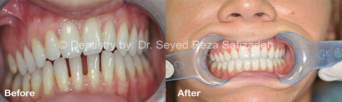 Before and After in Cosmetic Dentistry