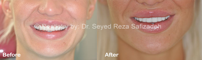 Before and After in Cosmetic Dentistry