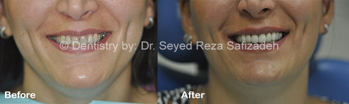 Before and After in Cosmetic Dentistry