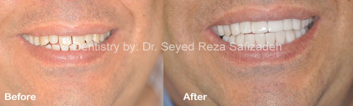 Before and After in Cosmetic Dentistry