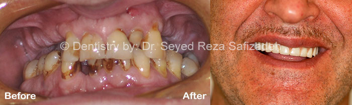 Before and After for Dental Implants