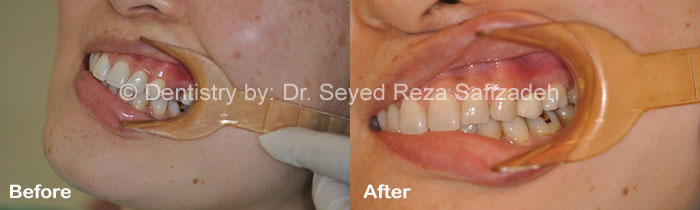 Before and After for Dental Implants