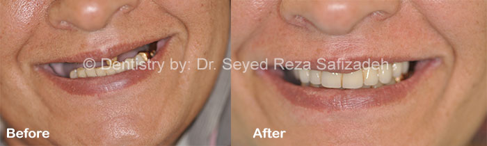 Before and After for Dental Implants