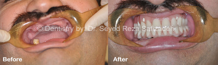 Before and After for Dental Implants