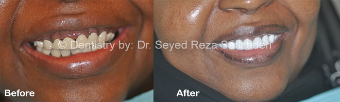 Before and After for Dental Implants